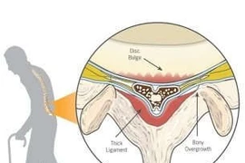 Các phương pháp chữa hẹp ống sống thắt lưng