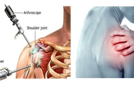 Tập phục hồi chức năng do rách chóp xoay