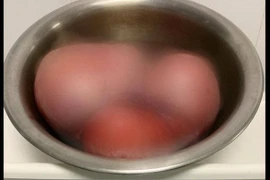 Phẫu thuật khối u xơ tử cung “khủng” 