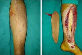 Dù vạt đùi trị hở cẳng chân: tránh cắt cụt