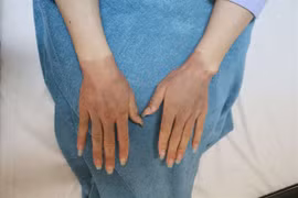 Gỡ bóng bay, 4 người bị bỏng