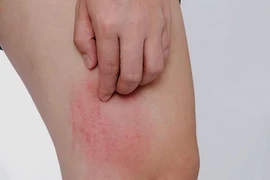 Chữa chứng ngứa da tái phát phải trị huyết