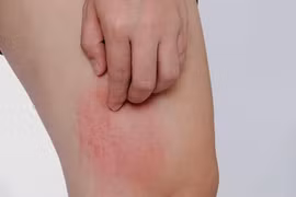 Chữa chứng ngứa da tái phát phải trị huyết