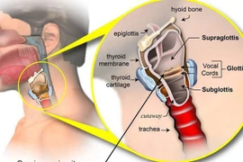 Triệu chứng của ung thư thanh quản