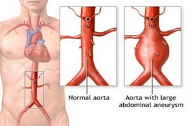Cảnh giác với phình động mạch chủ bụng ở người cao tuổi