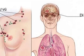 Ung thư vú di căn não