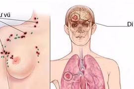 Ung thư vú di căn não