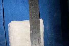 Sốt kéo dài do kim khâu trong cơ thể