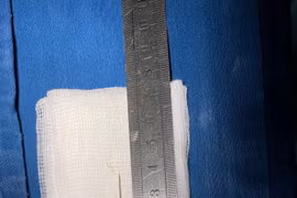 Sốt kéo dài do kim khâu trong cơ thể