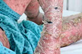  Điều trị bệnh vảy nến bằng thuốc sinh học