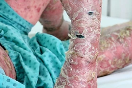  Điều trị bệnh vảy nến bằng thuốc sinh học