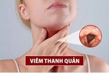 Đâu là cách đối phó với viêm thanh quản cấp ở người lớn an toàn nhất hiện nay?