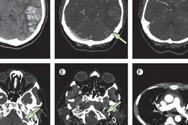 Biểu hiện huyết khối trên phim chụp.