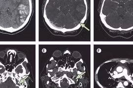 Biểu hiện huyết khối trên phim chụp.