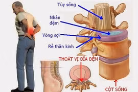 10 biểu hiện mắc thoát vị đĩa đệm