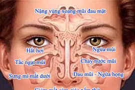 Kiểm soát để viêm mũi dị ứng không chuyển thành hen 