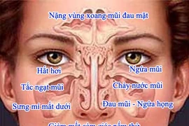 Kiểm soát để viêm mũi dị ứng không chuyển thành hen 