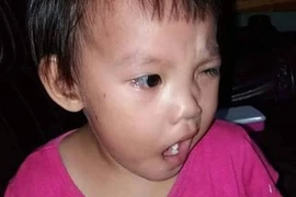 Nằm quạt và điều hòa sai cách trẻ có thể méo miệng