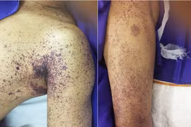 Cận tết, cảnh báo nguy cơ nhiễm liên cầu khuẩn lợn khi ăn tiết canh