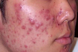 Thảo dược trị mụn trứng cá