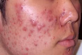 Thảo dược trị mụn trứng cá