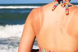 Khắc phục cháy nắng bằng vật liệu tự làm