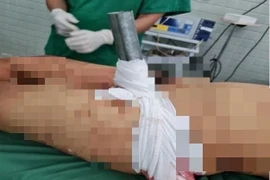 Cứu nạn nhân bị ống sắt lan can cầu đâm xuyên vùng bẹn 