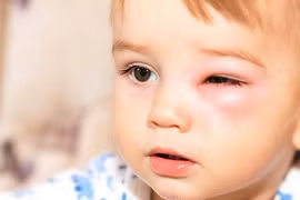 Mất thị lực vì coi thường vết xước ở mắt