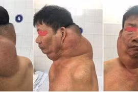 Phẫu thuật khối u khổng lồ cho “người gấu”
