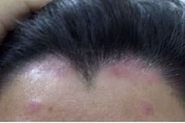 Vảy nến: Lành tính nhưng khó chữa