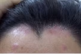 Vảy nến: Lành tính nhưng khó chữa