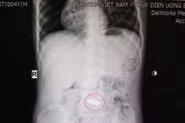 Ngậm đồng xu chui xuống dạ dày