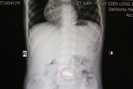 Ngậm đồng xu chui xuống dạ dày