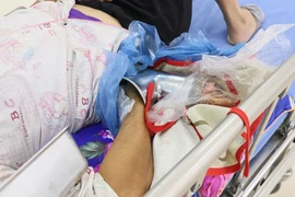 Cuốn tay vào máy xay thịt