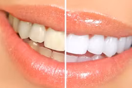 5 sai lầm khi vệ sinh răng miệng 