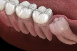 Khi nào nên nhổ răng khôn?