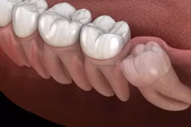 Khi nào nên nhổ răng khôn?