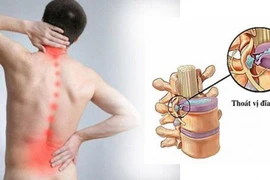 Người bị thoát vị đĩa đệm có nên tập thể thao?