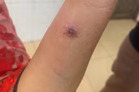 Điện Biên ghi nhận trường hợp trẻ nhỏ mắc bệnh than: Vì sao hiếm gặp?