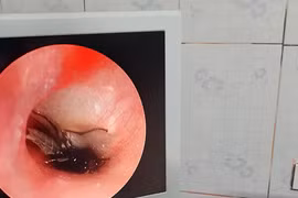 Bé trai 2 tuổi ở Hà Tĩnh bị gián chui vào tai