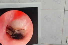 Bé trai 2 tuổi ở Hà Tĩnh bị gián chui vào tai