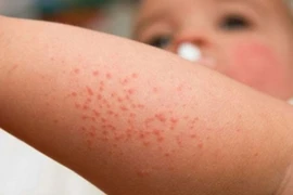 Trẻ con tắm nước lá gì vào mùa hè để trị rôm sảy