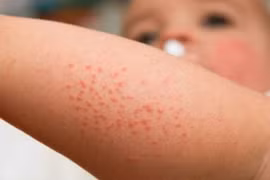 Trẻ con tắm nước lá gì vào mùa hè để trị rôm sảy