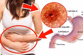 6 loại thực phẩm giúp cải thiện viêm loét dạ dày