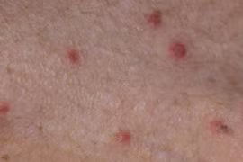 Hơn 140 người cùng một thôn ở Quảng Ngãi mắc bệnh ghẻ