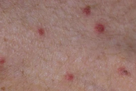 Hơn 140 người cùng một thôn ở Quảng Ngãi mắc bệnh ghẻ