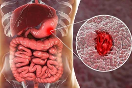 5 thực phẩm cực tốt cho bệnh nhân chảy máu dạ dày