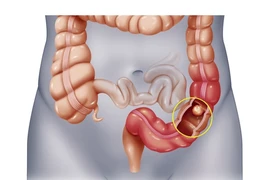 Người ung thư trực tràng nên ăn gì để tốt cho cơ thể?