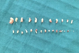 Hơn 28 chiếc răng dị dạng trong khối u của bé trai 9 tuổi