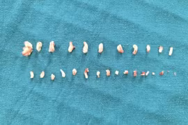 Hơn 28 chiếc răng dị dạng trong khối u của bé trai 9 tuổi